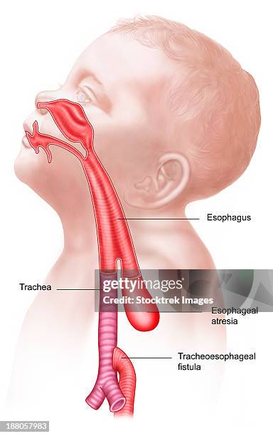 anatomy of a tracheoesophageal fistula. - pharynx stock illustrations