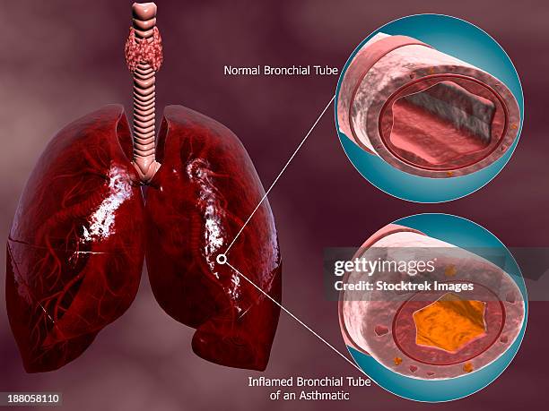 trachea cross-section with lungs, showing comparison of normal and asthmatic bronchiole. - bronchitis stock illustrations