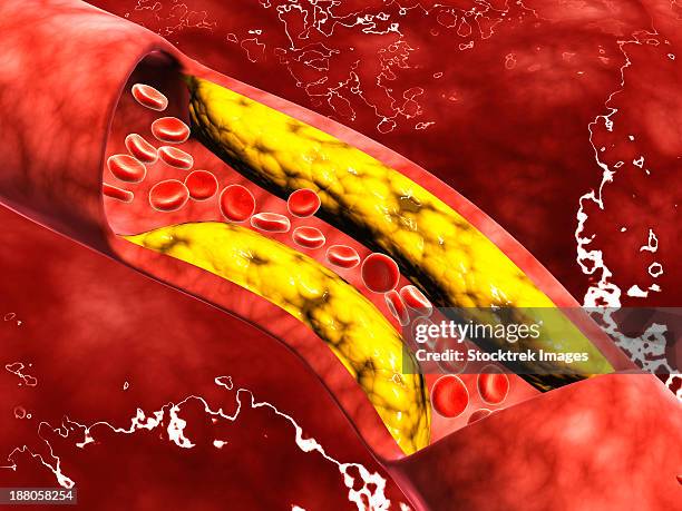 microscopic view of fat plaque inside the artery. - atherosklerose stock-grafiken, -clipart, -cartoons und -symbole
