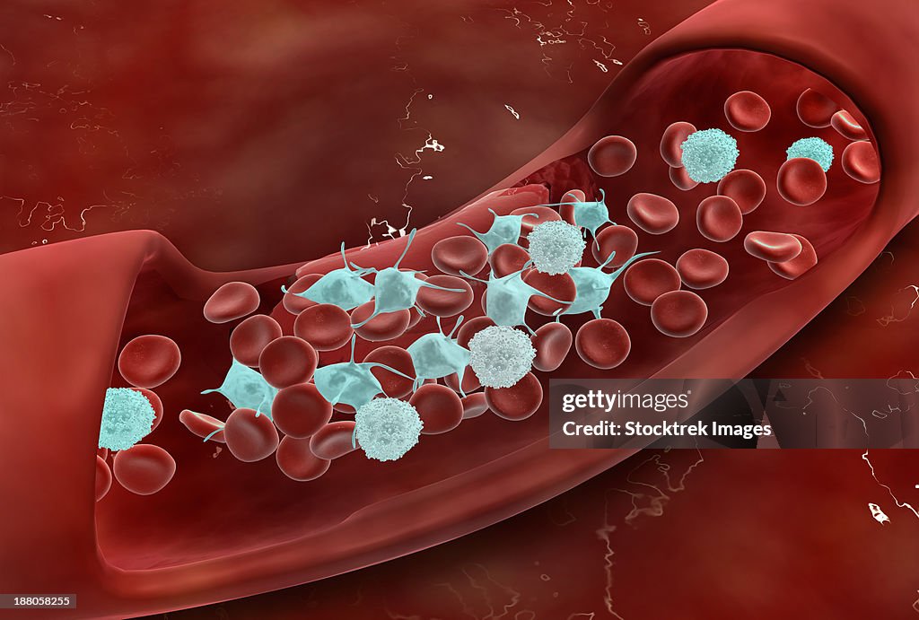 Microscopic view of blood clotting inside the artery.