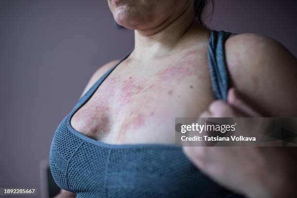 unidentified in a sports bra, a woman bears the visible impact of seasonal atopic dermatitis. skin becomes a canvas, revealing the complexities of flare-ups. - dermatitis stock pictures, royalty-free photos & images