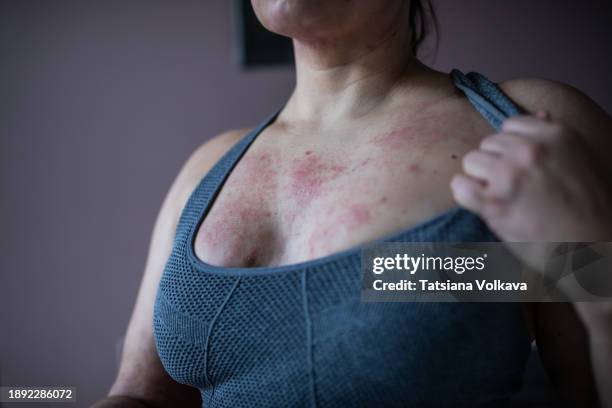 concealed in a sports bra, a woman navigates the seasonal battle of atopic dermatitis. her skin, marked by flare-ups, reflects a journey of endurance. - atopic dermatitis stock-fotos und bilder