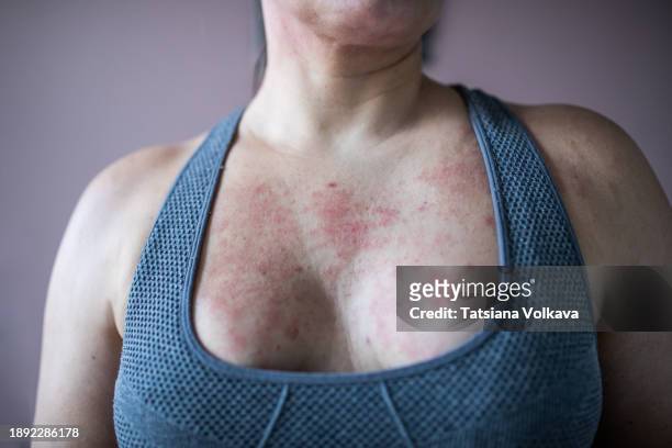 anonymous in a sports bra, a woman's skin reveals the seasonal challenge of atopic dermatitis. each flare-up marks a chapter in her journey of strength. - atopic dermatitis stock-fotos und bilder
