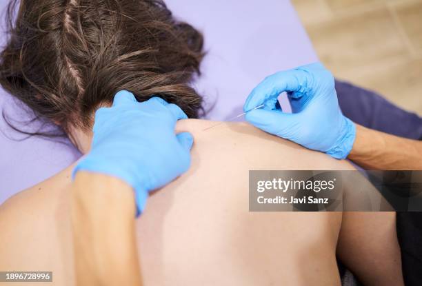 woman receiving acupuncture treatment in the physiotherapy clinic - acupuncture needle stock pictures, royalty-free photos & images
