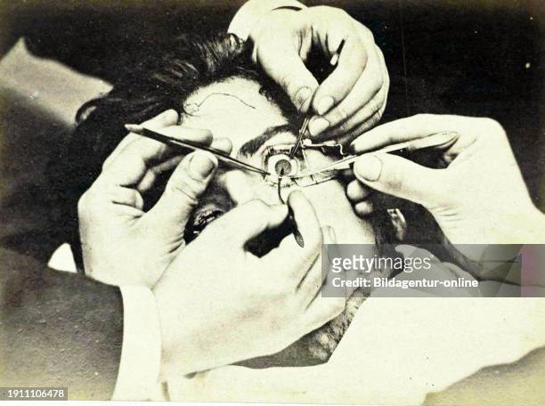 Medicine, anatomy, displacement of part of the iris during eye surgery France, Historical, digitally restored reproduction from a 19th century...