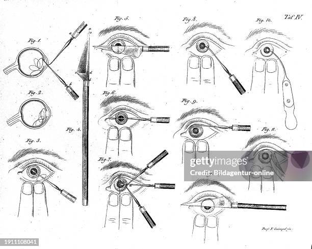 Medicine, anatomy, operation, steps of an eye surgery, around 1700, Historical, digitally restored reproduction from a 19th-century original.