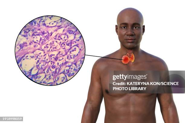 thyroid cancer, illustration - man 50 white background stock illustrations