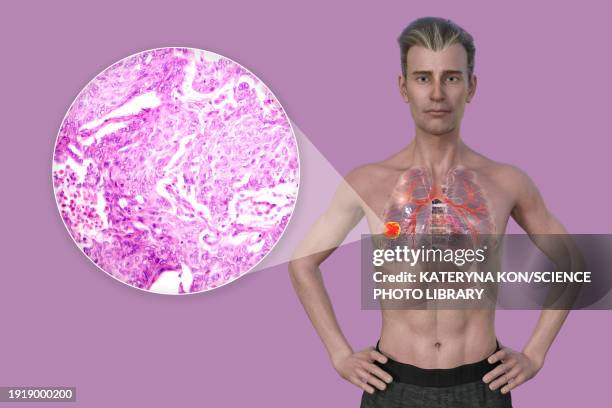 man with lung cancer, illustration - 光学顕微鏡図点のイラスト素材／クリップア��ート素材／マンガ素材／アイコン素材