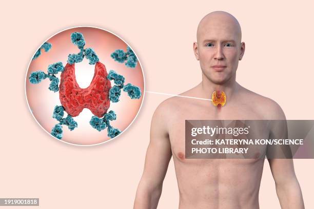 autoimmune thyroiditis, illustration - hashimotos thyroiditis stock illustrations