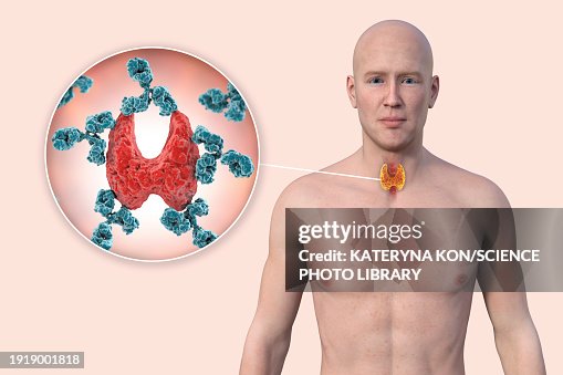 Autoimmune thyroiditis, illustration Autoimmune thyroiditis, illustration
