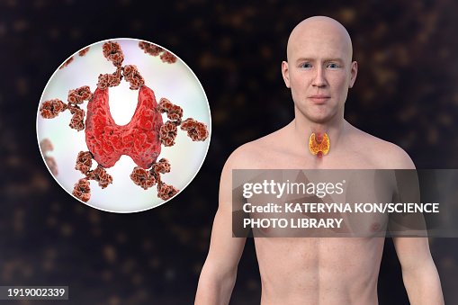 Autoimmune thyroiditis, illustration Autoimmune thyroiditis, illustration