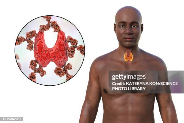 autoimmune thyroiditis, illustration - hashimotos thyroiditis stock illustrations