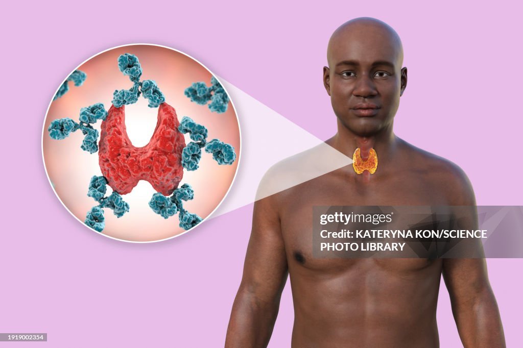 Autoimmune thyroiditis, illustration