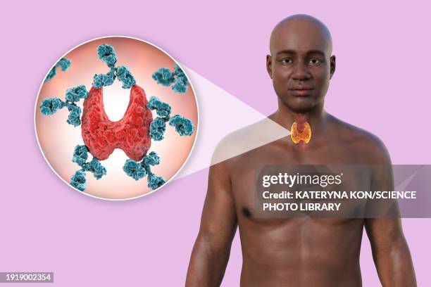 autoimmune thyroiditis, illustration - hashimotos thyroiditis stock illustrations