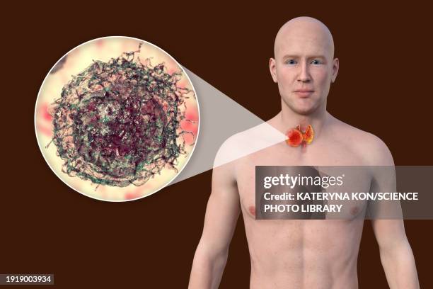 thyroid cancer, illustration - thyroid hormone stock illustrations