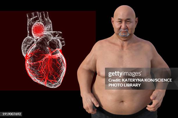 obese man with ascending aortic aneurysm, illustration - man black background stock illustrations