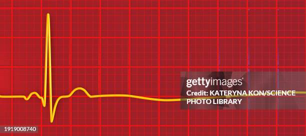 asystole cardiac arrest, illustration - stromschlag stock-grafiken, -clipart, -cartoons und -symbole