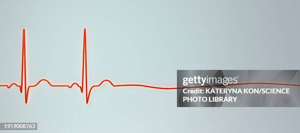 asystole cardiac arrest, illustration - stromschlag stock-grafiken, -clipart, -cartoons und -symbole