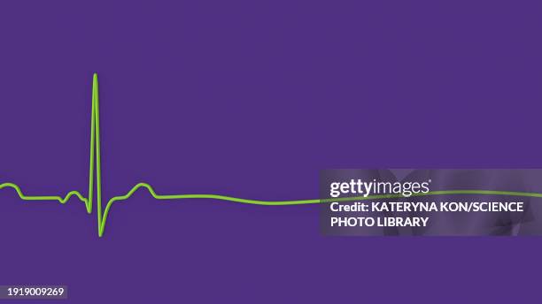 asystole cardiac arrest, illustration - stromschlag stock-grafiken, -clipart, -cartoons und -symbole