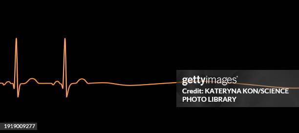 asystole cardiac arrest, illustration - stromschlag stock-grafiken, -clipart, -cartoons und -symbole