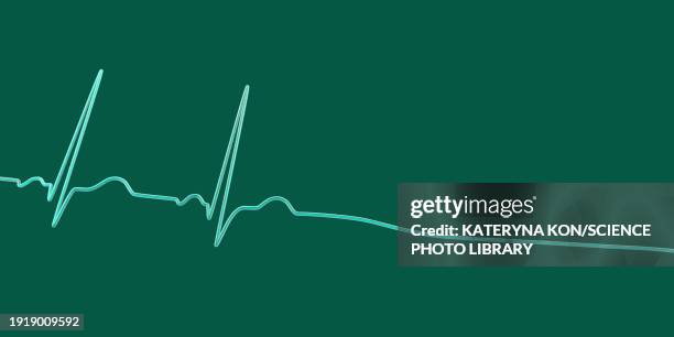 asystole cardiac arrest, illustration - stromschlag stock-grafiken, -clipart, -cartoons und -symbole