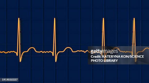 atrial fibrillation irregular heartbeat rhythm, illustration - atrial fibrillation stock illustrations
