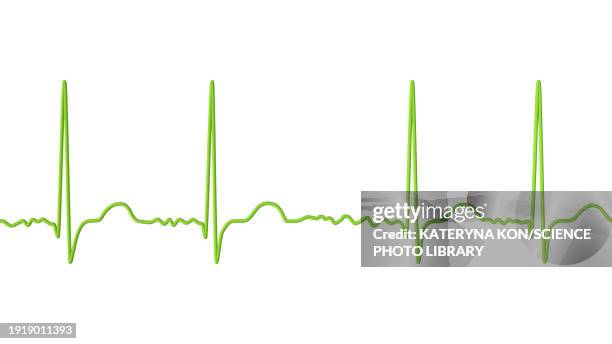 atrial fibrillation irregular heartbeat rhythm, illustration - atrial fibrillation stock illustrations