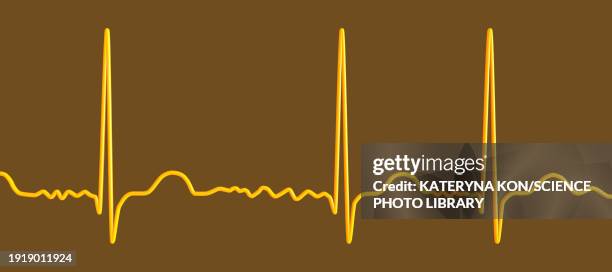 atrial fibrillation irregular heartbeat rhythm, illustration - atrial fibrillation stock illustrations