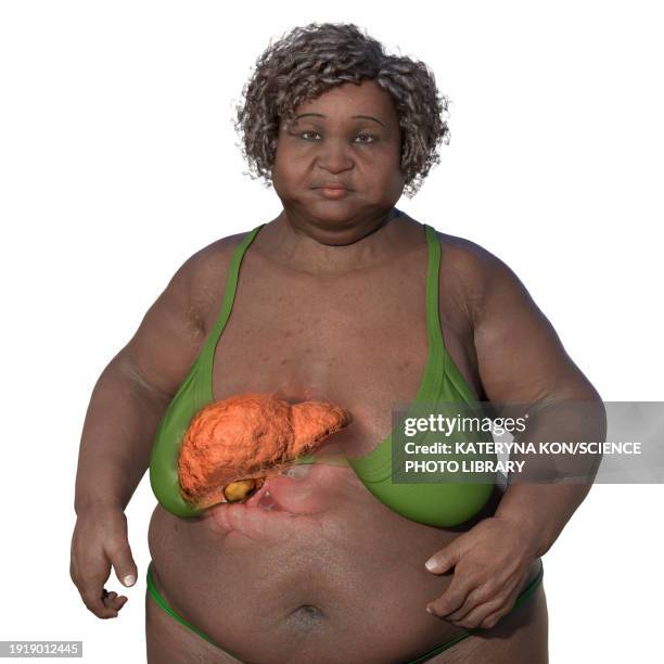 overweight woman with liver steatosis, illustration - human liver stock illustrations