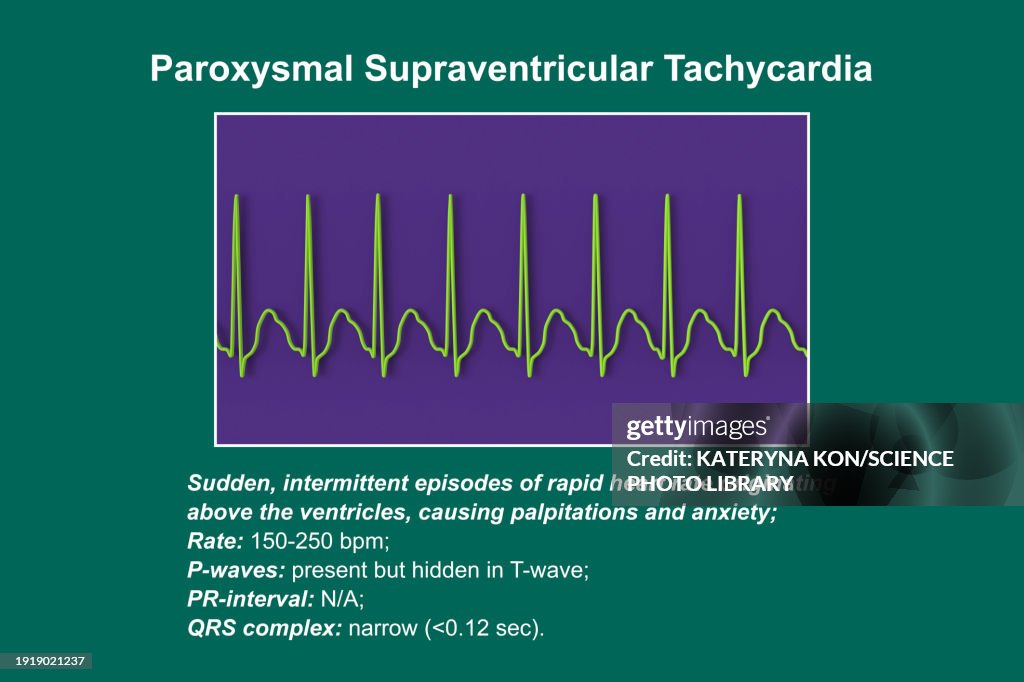 Svt R Supraventricular Tachycardia Svt Causes Symptoms