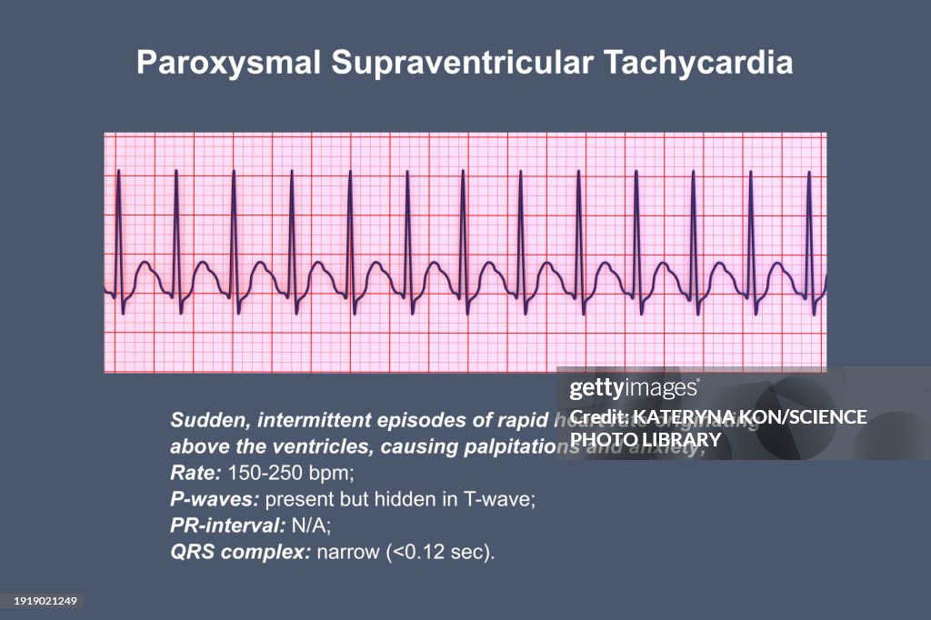 Supraventricular Tachycardia Heartbeat Rhythm Illustration High Res supraventricular-tachycardia-heartbeat-rhythm-illustration-high-res