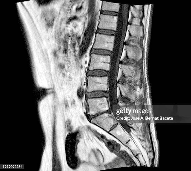 Lateral View Of An Mri Of The Spine Affected By A Herniated Disc