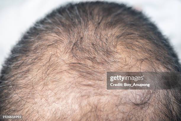 cropped shot view of dandruff problem on men's head. dandruff is a skin condition that causes itchy. - ugly bald man stock pictures, royalty-free photos & images