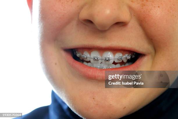 close-up of boy in braces - apparecchio ortodontico foto e immagini stock
