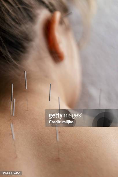 patient getting acupuncture back treatment - acupuncture needle stock pictures, royalty-free photos & images