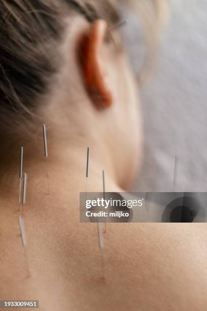 patient getting acupuncture back treatment - acupuncture needle 個照片及圖片檔