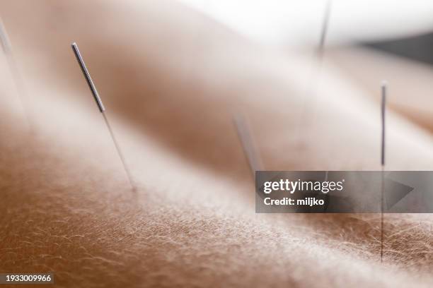 patient getting acupuncture back treatment - acupuncture needle stock pictures, royalty-free photos & images