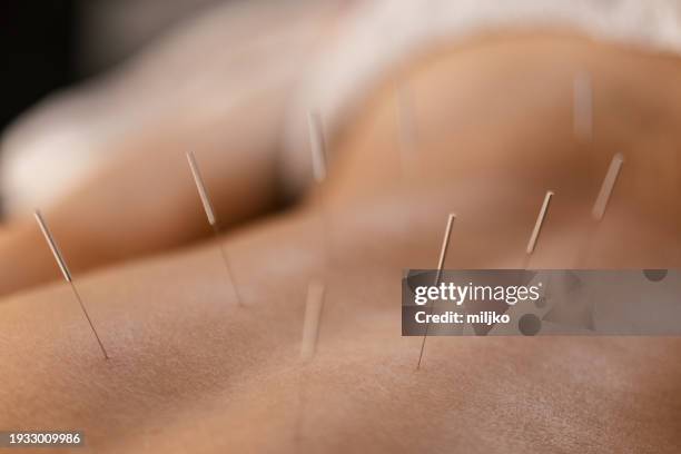 patient getting acupuncture back treatment - acupuncture needle stock pictures, royalty-free photos & images