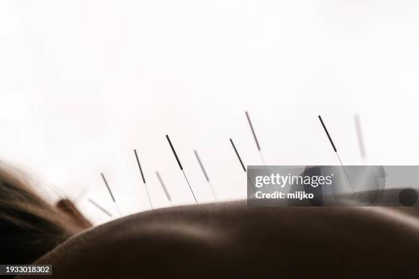 patient getting acupuncture back treatment - acupuncture model stock pictures, royalty-free photos & images