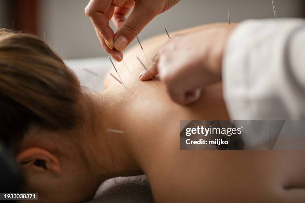 acupuncture back treatment, therapist and patient - akupunktur stock-fotos und bilder