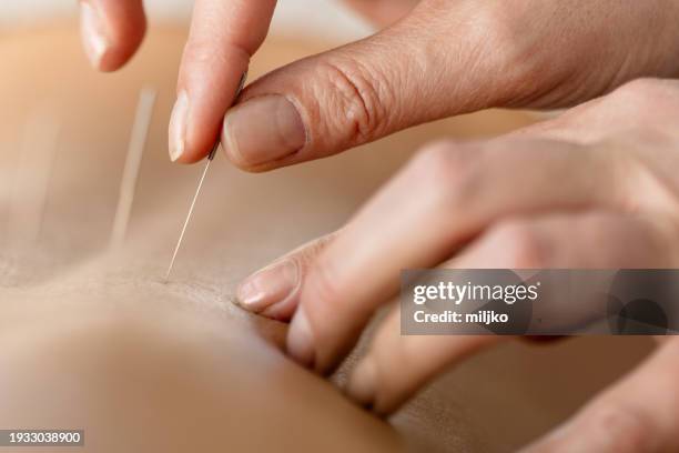 acupuncture back treatment - acupuncture needle stock pictures, royalty-free photos & images