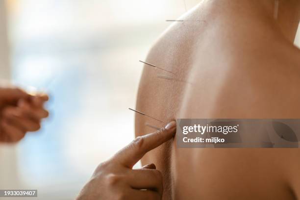 acupuncture back treatment, therapist and patient - acupuncture stock-fotos und bilder