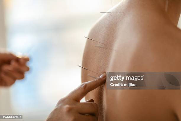 acupuncture back treatment, therapist and patient - agulha de acupuntura imagens e fotografias de stock