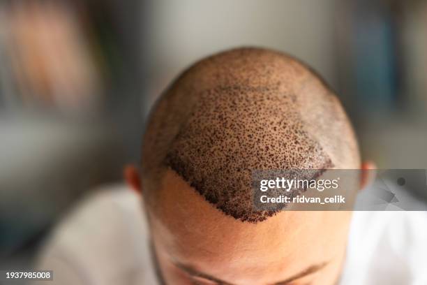 top view of scalp after hair transplant surgery - procedimento médico imagens e fotografias de stock