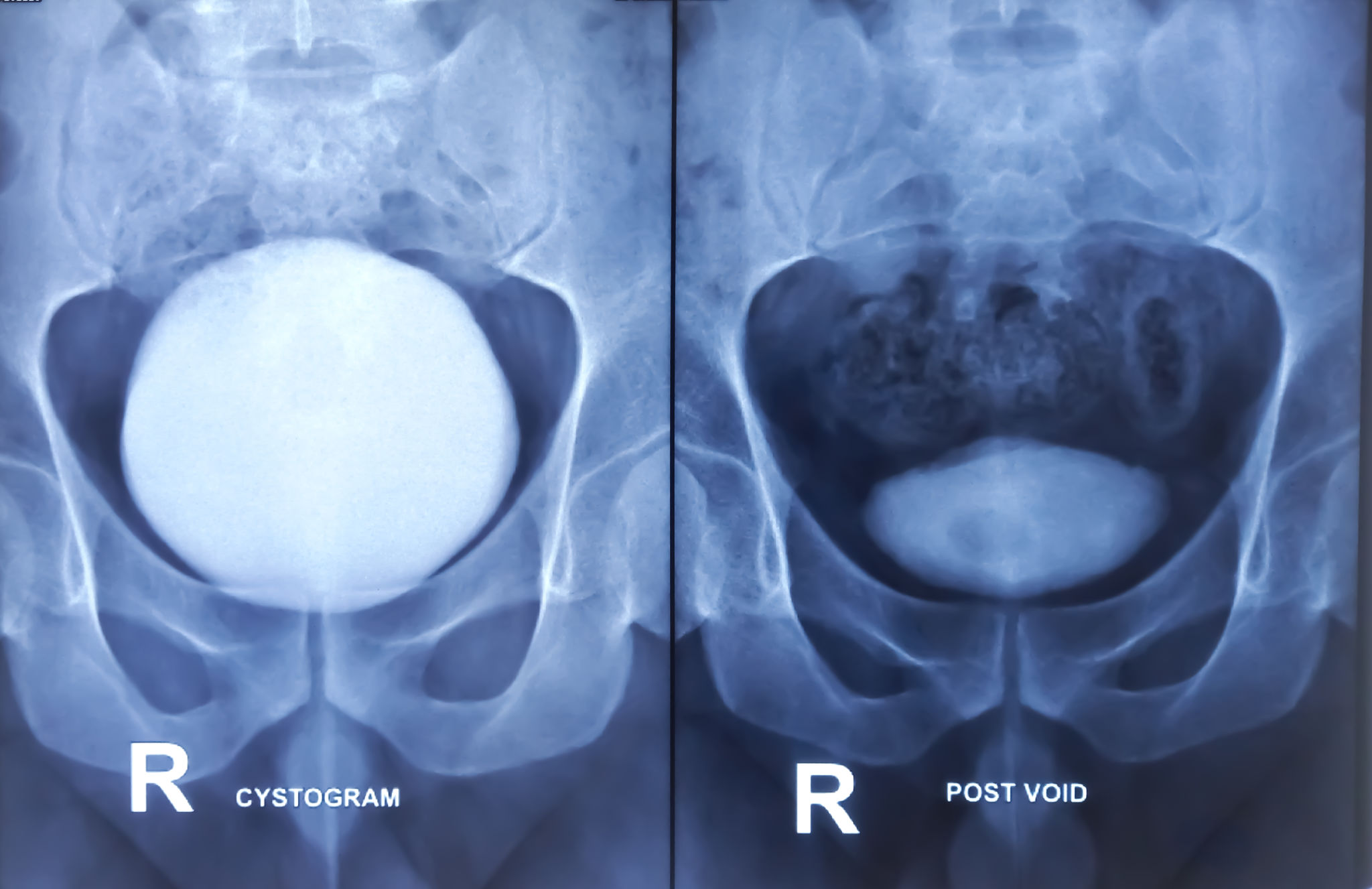 urodynamic testing
