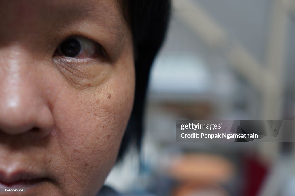 Keratitis Blepharitis eye woman