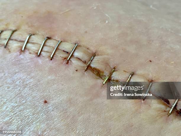 metal stitches - cucitura foto e immagini stock