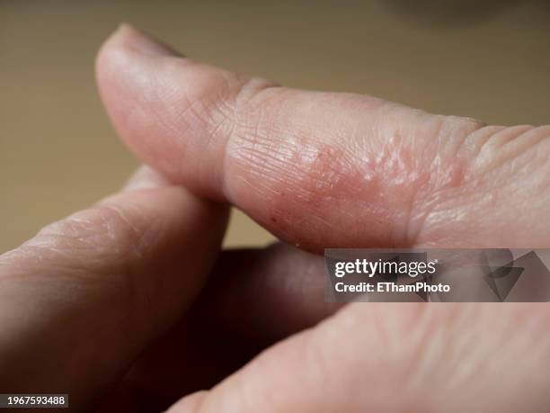 Bumpy Hand Rash 174 Eczema Blisters Stock Photos, High-Res Pictures, and Images - Getty ...