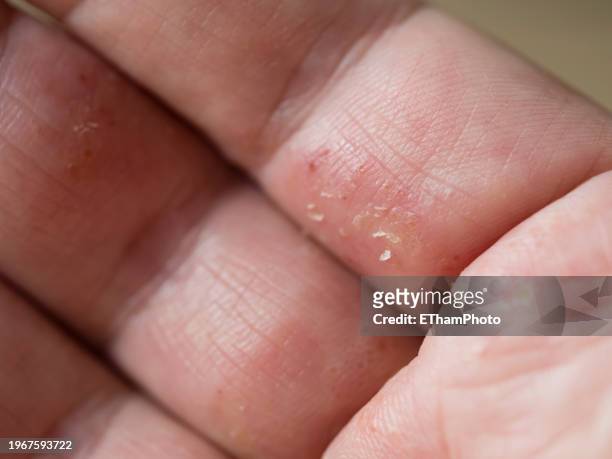 atopic dermatitis eczema on hand and fingers - atopic dermatitis stock-fotos und bilder