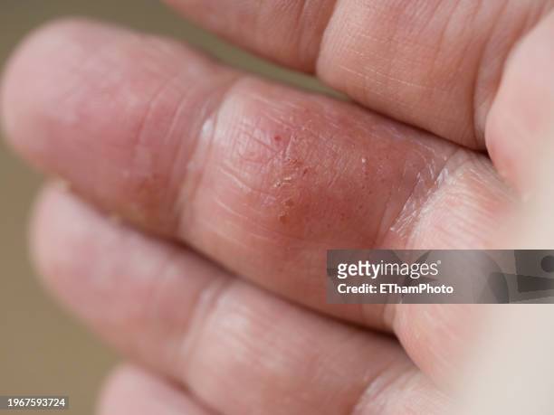 atopic dermatitis eczema on hand and fingers - atopic dermatitis stock-fotos und bilder